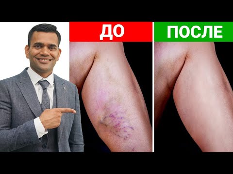 Видео: Избавьтесь От Варикозного Расширения Вен И Холодных Ног