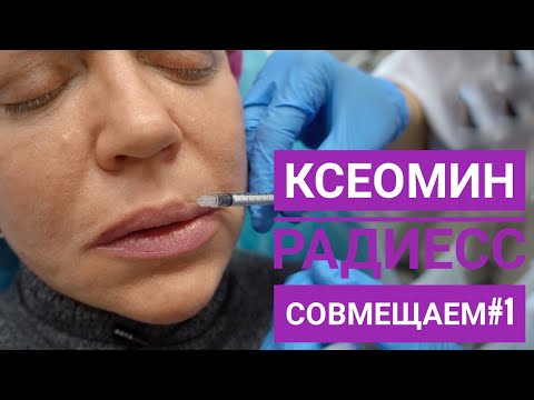 Видео: Совмещаем ботулотоксин (Ксеомин) и инъекции Радиесс. Часть 1-я