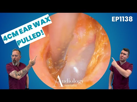 Видео: Ушная серная пробка 4 см + глубокий пилинг кожи! Удовлетворительные результаты удаления зубов и х...