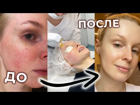 Видео: Как ИЗБАВИТЬСЯ от КУПЕРОЗА, РОЗАЦЕА и чувствительности | Процедуры у косметолога: БОТОКС, IPL и BBL