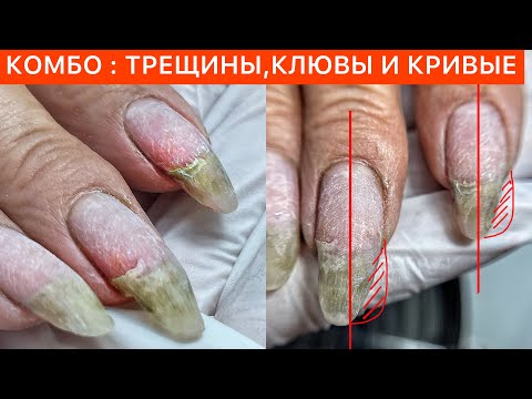 Видео: ПОЛНАЯ РЕСТАВРАЦИЯ🚨ВЕРХНИЕ ФОРМЫ + ГЕЛЬ +СТЕКЛОВОЛОКНО ⚠️ТМ NailApex 🧐🤍
