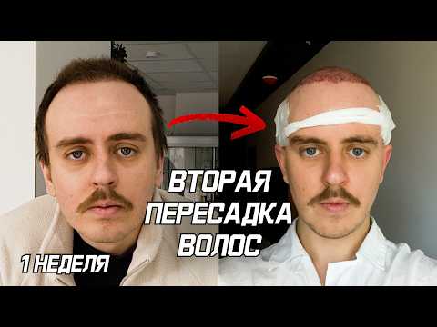 Видео: Моя вторая пересадка волос, подробнее некуда