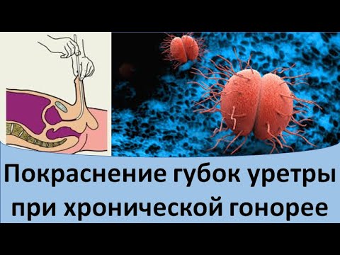 Видео: Покраснение губок уретры при хронической гонорее