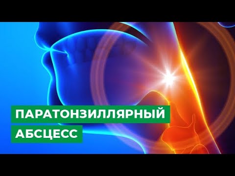 Видео: Паратонзиллярный абсцесс