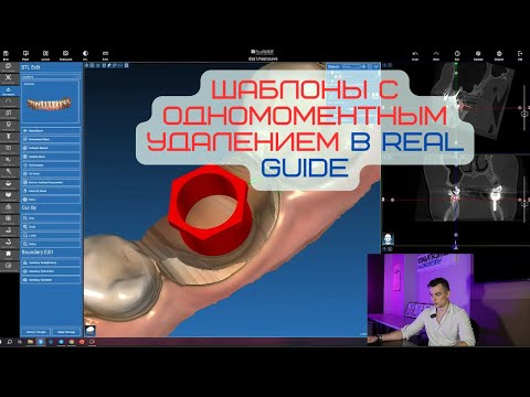 Видео: Шаблоны при одномоментном удалении зубов в Real Guide