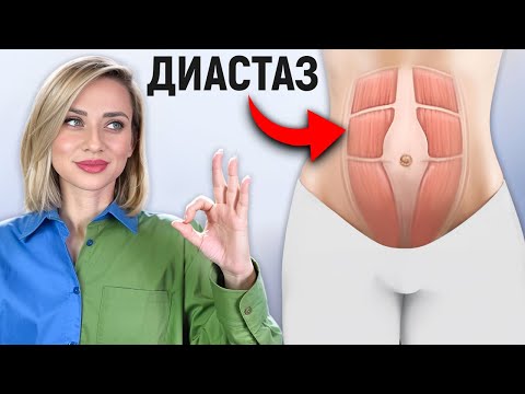 Видео: ДИАСТАЗ. Как собрать живот, если он провисает и расходится?