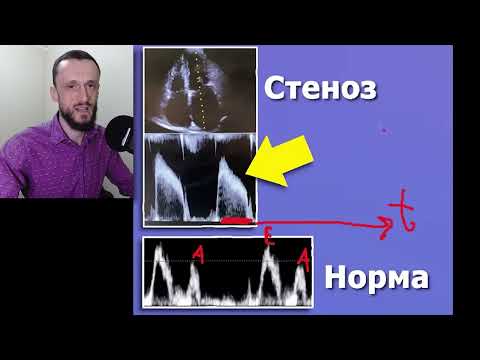 Видео: Стеноз Митрального Клапана | УЗИ сердца | Для врачей