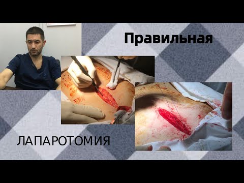 Видео: Правильная лапаротомия