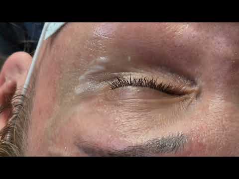 Видео: Мезоботокс  .