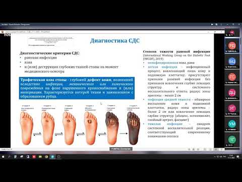 Видео: Синдром диабетической стопы: тактика ведения пациентов