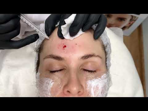 Видео: Процедура коллагена NITHYA. Классический метод инъецирования soft-pintch (мягкий щипок).