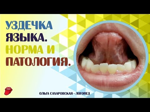 Видео: Как определить длину уздечки? Короткая уздечка языка и норма