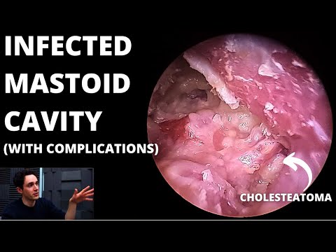 Видео: Инфицированная сосцевидная полость с холестеатомой (может потребоваться кондилэктомия)