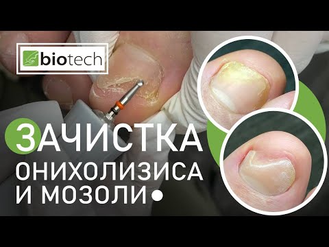 Видео: ОНИХОЛИЗИС! КАК ЕГО ЗАЧИЩАТЬ И ПОЧЕМУ ОН ВОЗНИК?!