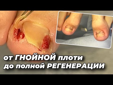 Видео: Новая жизнь даже в безнадежном  состоянии. Цикл от дикого мяса до стабильного состояния в 16 лет