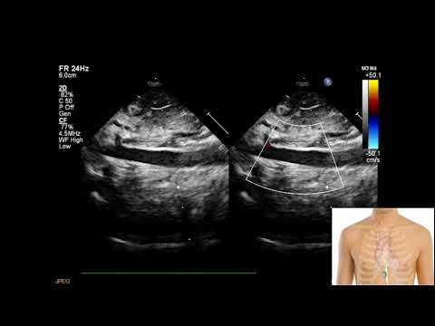 Видео: Протокол ЭхоКГ у детей субкостальное окно (рус.)