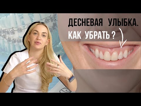 Видео: Десневая улыбка. Как исправить? Поможет ортодонт, хирург или косметолог?
