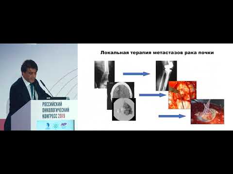 Видео: Хирургическое лечение распространенных форм опухолей в онкоурологии