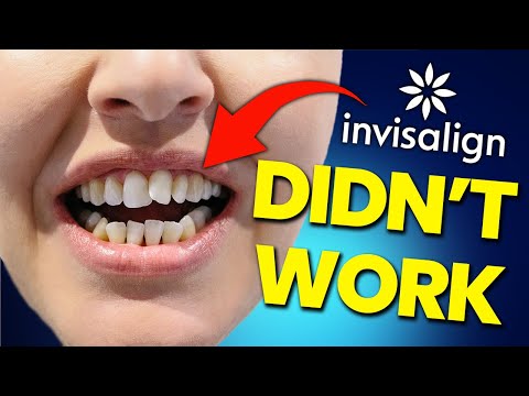 Видео: СУРОВАЯ ПРАВДА об Invisalign...посмотрите, прежде чем купить