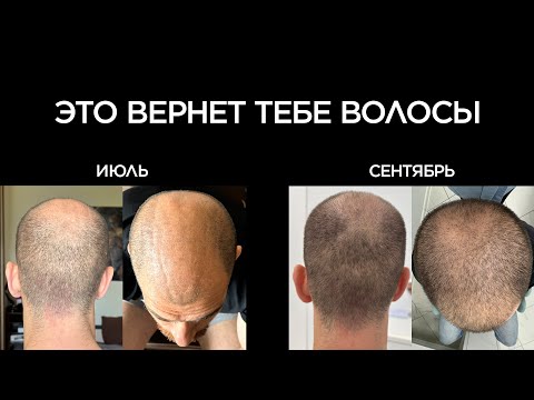 Видео: Возвращаем здоровые волосы за 4 месяца (без пересадки)