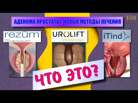 Видео: Аденома простаты - новые малоинвазивные методы лечения