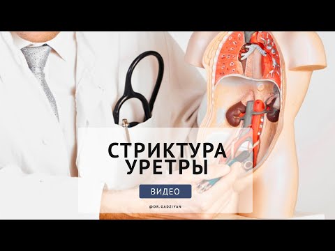 Видео: СТРИКТУРА УРЕТРЫ