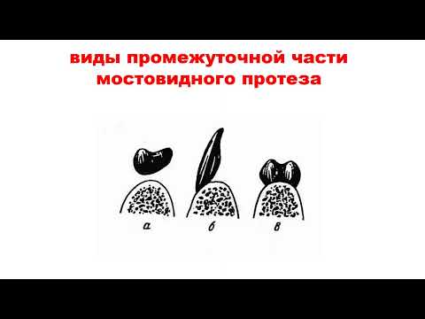 Видео: Принципы ортопедического лечения частичного отсутствия зубов различными видами мостовидных протезов