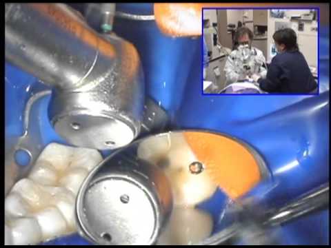 Видео: Доктор Дэвид Кларк "Современные методы лечения дефектов I класса и герметизации фиссур"