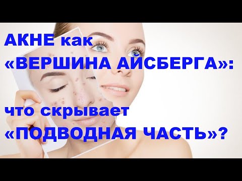 Видео: Короткова Н.А. Акне как «вершина айсберга»: что скрывает «подводная часть»?