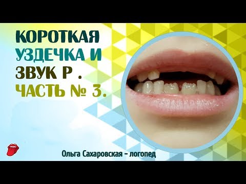 Видео: Короткая уздечка языка и звук Р. Одноударный звук Р в слогах. Часть № 3