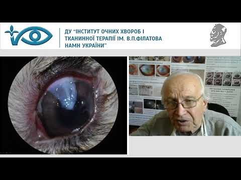 Видео: Птеригиум. Мальцев Э.В.  Часть 2