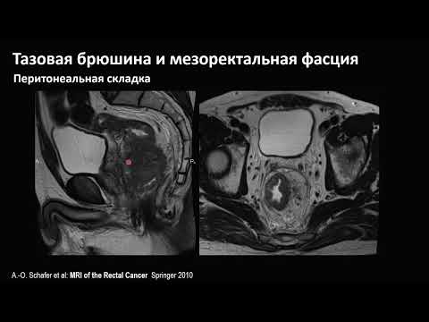 Видео: МРТ. Опухоли прямой кишки 2