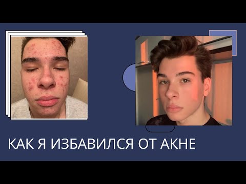 Видео: Как я избавился от акне| МОЯ ИСТОРИЯ АКНЕ
