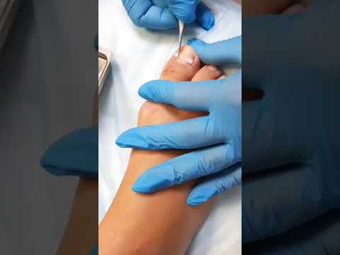 Видео: Установка BS пластины (лечение вросшего ногтя) - Эстетико-подологический центр Елены Басковой