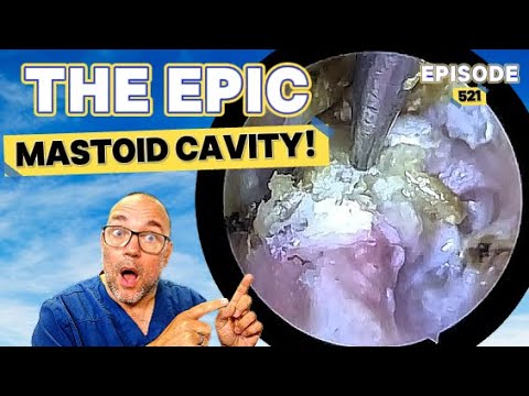 Видео: ГРАНДИОЗНАЯ СОСЦЕВИДНАЯ ПОЛОСТИ! Эпизод 523 (невероятно сложный!)