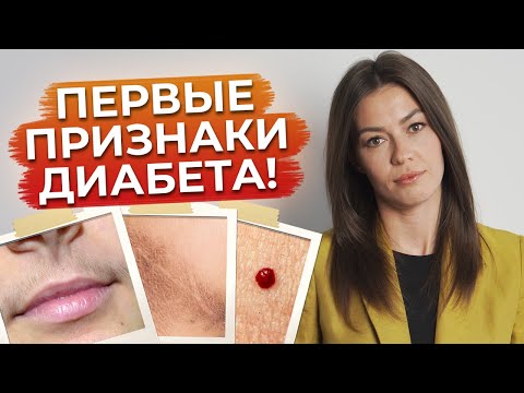 Видео: Как не допустить сахарный диабет? / Признаки сахарного диабета
