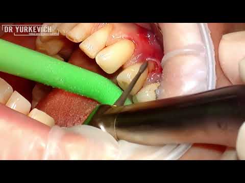 Видео: Закрытие одиночной рецессии десны | Забор ССТ через 1 разрез | Single gum recession closure with CTG