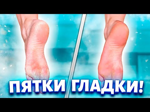 Видео: Шершавые пятки, трещины и грибок — как я спасаю ноги осенью.