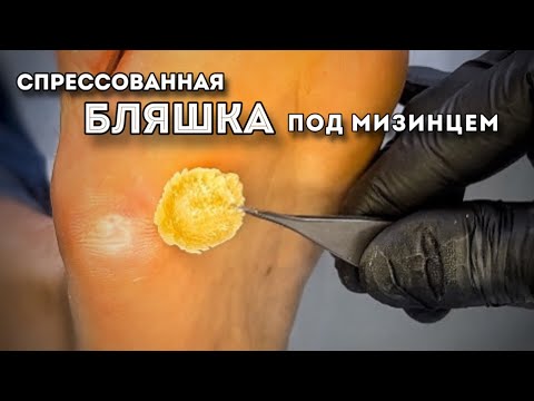 Видео: Кожное болезненное уплотнение под мизинцем. Почему постоянно нарастает