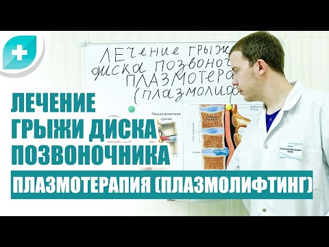 Видео: Лечение грыжи диска позвоночника плазмотерапия (плазмолифтинг)