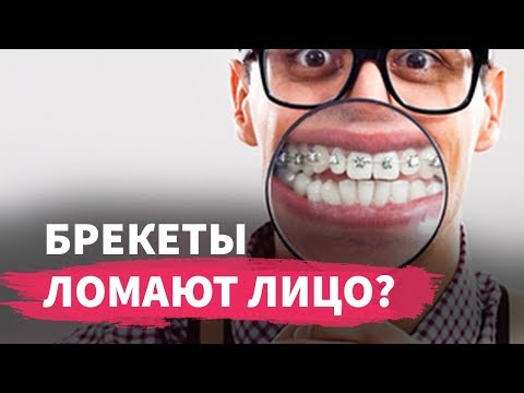 Видео: Брекеты ломают лицо?