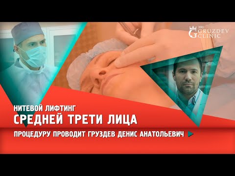 Видео: Нитевой лифтинг средней трети лица