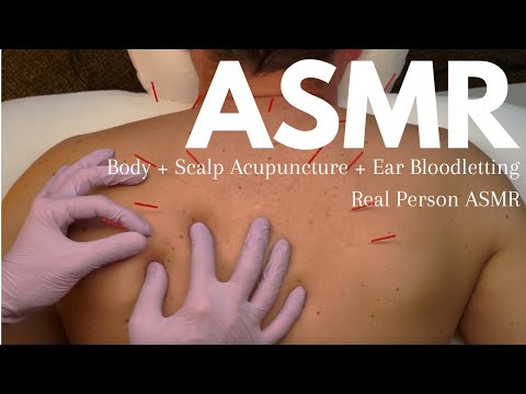 Видео: Лечение иглоукалыванием верхней части спины и кожи головы (и НЕМНОГО кровопускания) 😇❣️ [ASMR от ...