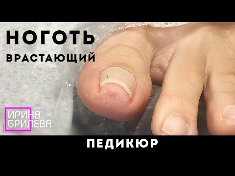 Видео: ПЕДИКЮР 🌸 Вросший ноготь / Ноготь, склонный к врастанию