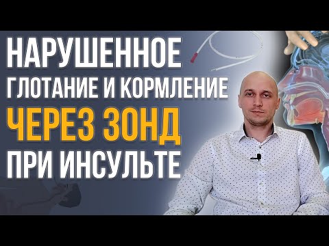 Видео: Нарушение глотания (дисфагия) после инсульта и кормление через назогастральный зонд