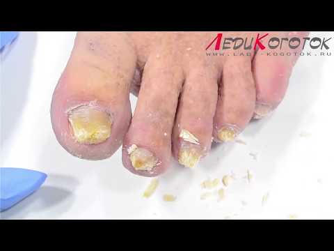 Видео: Восстановление травмированных ногтей!