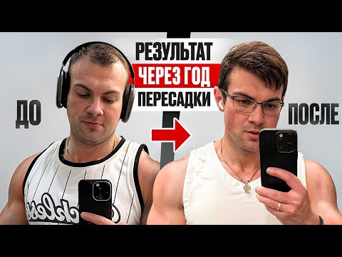 Видео: Мой опыт пересадки волос.