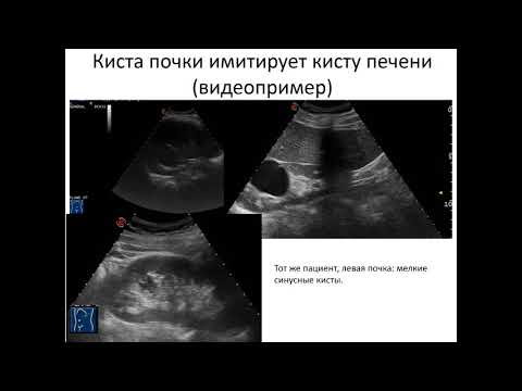 Видео: ЭХОСТРУКТУРНЫЕ ИЗМЕНЕНИЯ ПОЧЕК.  Часть 2.