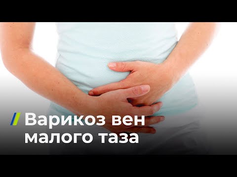 Видео: Варикоз вен малого таза
