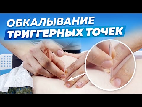 Видео: Все про ОБКАЛЫВАНИЕ Триггерных Точек